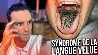 Les plus étranges syndromes (syndrome de la langue velue)