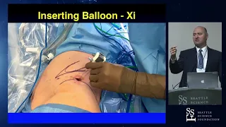 Retroperitoneal Partial Nephrectomy presented by James Porter, MD