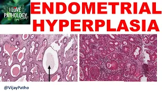 ENDOMETRIAL HYPERPLASIA : Etiopathogenesis, classification Diagnosis & treatment
