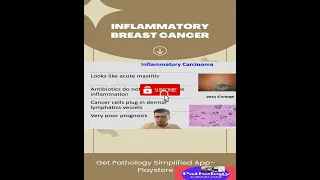 Inflammatory Breast Cancer(#Shorts)|Can inflammatory breast cancer appear suddenly?usmle,neetpg,plab