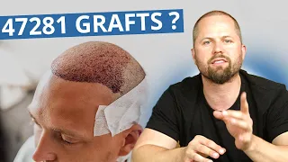 Wie viele Grafts können maximal entnommen werden? | Haartransplantation