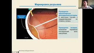 Отслойка сетчатки. Витреоретинальная хирургия