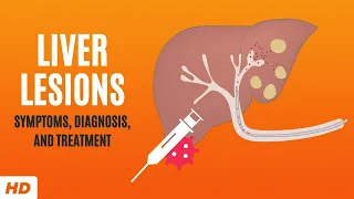 Liver Lesions: Symptoms, Diagnosis and Treatment