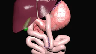 Gastric Bypass Surgery Roux-en-Y Animation by Cal Shipley, M.D.