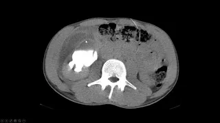 Urinoma traumático em rim com hidronefrose