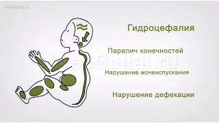 Спина бифида – симптомы и осложнения