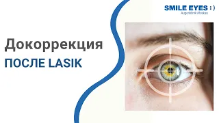 Докоррекция после LASIK - возможности и как проходит?