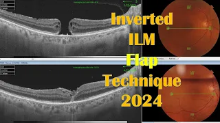 Macular Hole Inverted ILM Flap Technique 2024