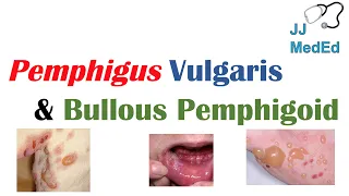 Vesiculobullous Skin Diseases | Pemphigus Vulgaris vs. Bullous Pemphigoid