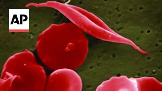 Two gene therapies for sickle cell disease approved in US