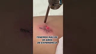 Tratamiento Removal Láser