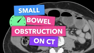 Small bowel obstruction on CT - Radiopaedia's Emergency Radiology Course