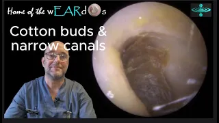 Cotton buds and narrow canals - Ep 120 #ear #earwax #earwaxremoval #earcleaning #earwaxclinic