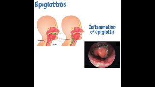 Croup vs. Epiglottitis vs. Bronchiolitis