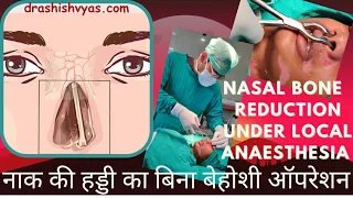 Nasal Bone Fracture Reduction Surgery Local Anaesthesia बिना बेहोश नाक की हड्डी की प्लास्टिक सर्जरी