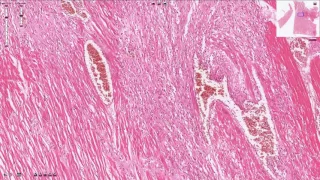 Myocardial Infarction - Histopathology