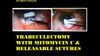 TRABECULECTOMY WITH MITOMYCIN C & RELEASABLE SUTURES