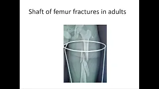 Shaft of femur fractures in adults and paediatric age group