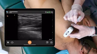 Ultrasound Guided PRP Injection