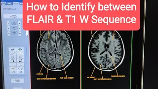 FLAIR vs T1 weighted MRI images | how to tell the difference.