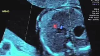 HRHS Pulmonary Atresia Intact Venyricular Septum