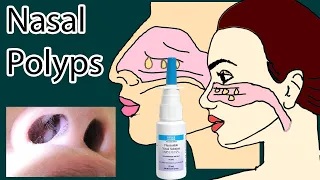 Nasal Polyps symptoms, causes  and treatment