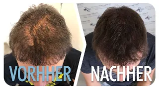 Haarpigmentierung nach einer Haartransplantation Türkei | TV - Reportage