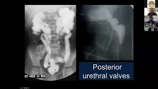 Management  of UTI in children - Saudi Urological Association webinar