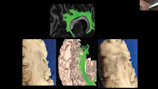 Jordan Neurosurgery Grand Rounds April 10, 2019: Butterfly Gliomas