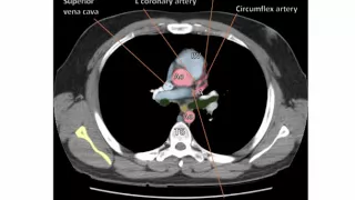 Anatomy of a Transverse CT of the Thorax