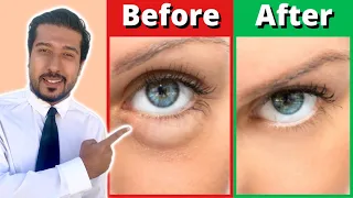 How to Get Rid of Puffy Eyes and Bags in 5 Fast Steps