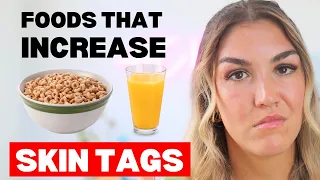 4 Foods to Stop Eating That Cause Skin Tags (Acrochordons)