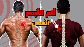 السبب الخفي لألم الأبهر | عالج ألم منتصف الظهر الآن وللأبد 👌