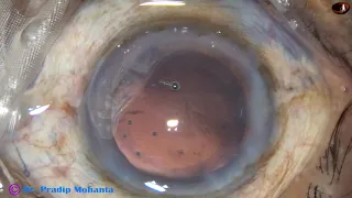 An intumescent cataract looking like an Immature Senile Cataract : Pradip Mohanta, 13th May, 2020