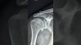 Glenohumeral osteoarthritis -X ray
