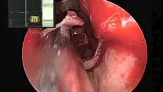 Mucoceles of the Paranasal Sinuses