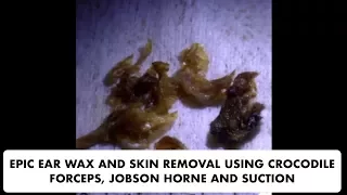 EPIC SKIN AND EAR WAX REMOVAL USING JOBSON HORNE, SUCTION AND CROCODILE FORCEPS - Ep 23