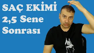 Saç Ekimi - 2.5 Yıl sonra