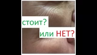 Мезотерапия вокруг глаз от от мешков и морщин под глазами. Как выбрать? Чего опасаться?