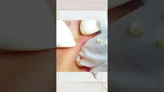 Big Cystic Acne Blackheads Extraction Blackheads & Milia, Whiteheads Removal Pimple Popping #shorts