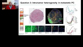 Spatial landscape of the immune microenvironment in metastatic prostate cancer...