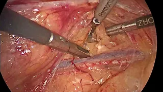 17 05 2022 Laparoscopic Left Nephrectomy / Лапароскопическая нефрэктомия слева