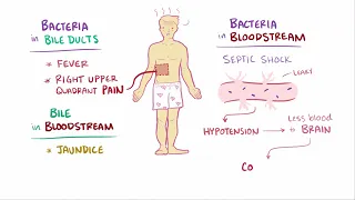 Ascending cholangitis acute cholangitis   causes, symptoms, diagnosis,   patho