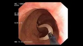 Ascaridosis on colonoscopy. Аскариды при колоноскопии