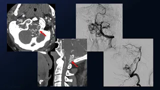 Far Lateral Craniotomy for Clip Ligation of a Marginal Sinus Dural Arteriovenous Fistula