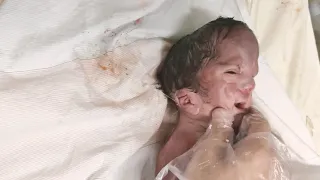 Newborn baby abandoned by parents due to congenital malformations just after birth  #birth