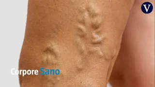 Cómo eliminar las varices de las piernas | Dr. Jorge Planas