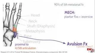 5th Metatarsal Fractures