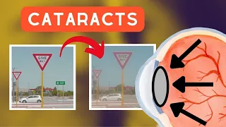 What CATARACTS do to your vision..