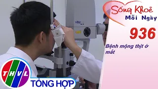 Bệnh mộng thịt ở mắt | Sống khỏe mỗi ngày - Kỳ 936